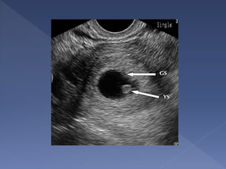  no yolk sac, where:
› MSD > 8 mm
› embryo seen
 irregular gestational sac
 low position of the gestational sac
 