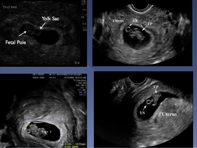 obstetrical ultrasound