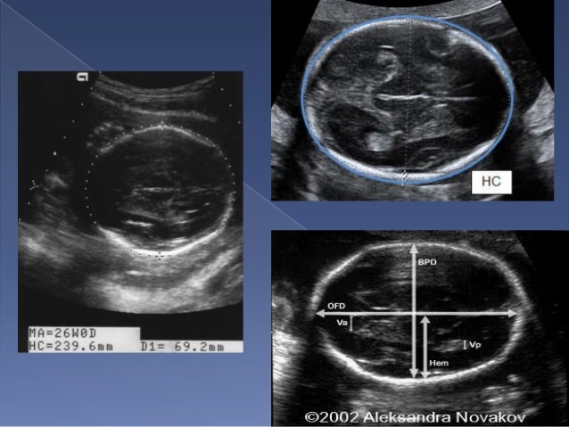 how measured is amniotic fluid Ultrasound Basic Obstetric