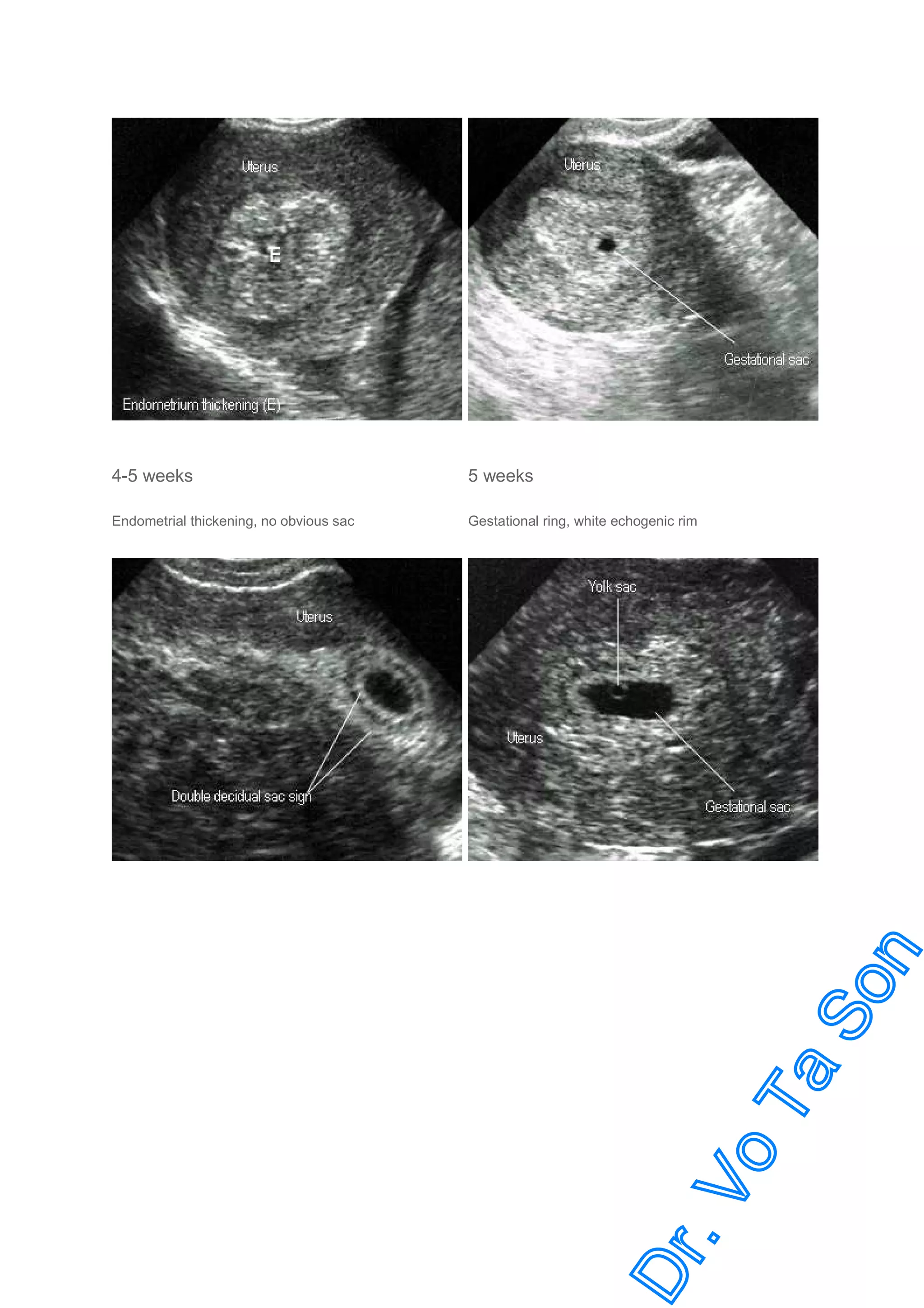 Basic ob ultrasound | PDF