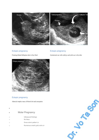 Ectopic pregnancy

Ectopic pregnancy

Floating dilated fallopian tube in free fluid

Gestational sac with embryo and yolk sac in the tube

Ectopic pregnancy
Adnexal omplex mass of blood clot and concepitus

•
•

Molar Pregnancy

o
o

Ultrasound findings:

o

Snow storm pattern or

o

Numerous small cystic echo or

No fetus

 