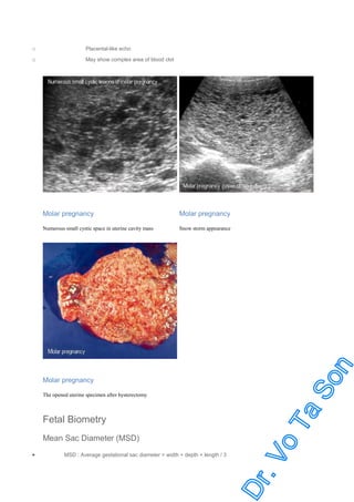 o

Placental-like echo

o

May show complex area of blood clot

Molar pregnancy

Molar pregnancy

Numerous small cystic space in uterine cavity mass

Snow storm appearance

Molar pregnancy
The opened uterine specimen after hysterectomy

Fetal Biometry
Mean Sac Diameter (MSD)
•

MSD : Average gestational sac diameter = width + depth + length / 3

 