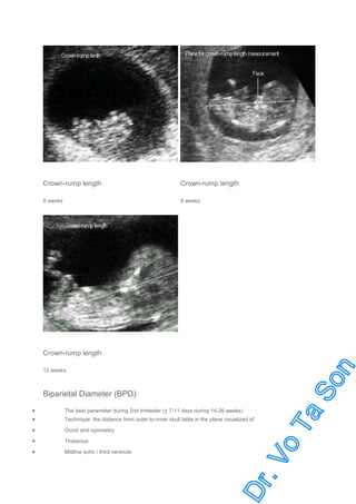 Crown-rump length

Crown-rump length

8 weeks

9 weeks

Crown-rump length
12 weeks

Biparietal Diameter (BPD)
•
•

The best parameter during 2nd trimester (+ 7-11 days during 14-26 weeks)

•

Ovoid and symmetry

•

Thalamus

•

Midline echo / third ventricle

Technique: the distance from outer-to-inner skull table in the plane visualized of

 