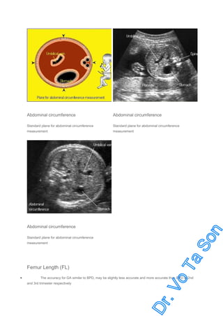 Abdominal circumference

Abdominal circumference

Standard plane for abdominal circumference

Standard plane for abdominal circumference

measurement

measurement

Abdominal circumference
Standard plane for abdominal circumference
measurement

Femur Length (FL)
•

The accuracy for GA similar to BPD, may be slightly less accurate and more accurate than BPD in 2nd
and 3rd trimester respectively

 