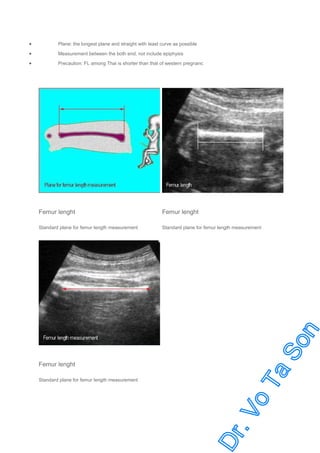 •

Plane: the longest plane and straight with least curve as possible

•

Measurement between the both end, not include epiphysis

•

Precaution: FL among Thai is shorter than that of western pregnanc

Femur lenght

Femur lenght

Standard plane for femur length measurement

Standard plane for femur length measurement

Femur lenght
Standard plane for femur length measurement

 