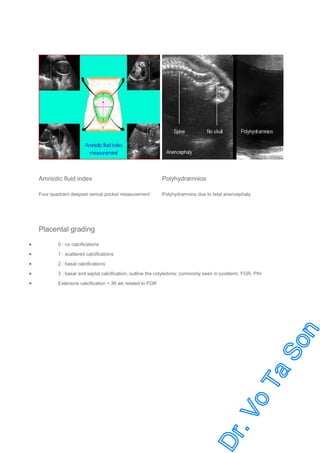 Amniotic fluid index

Polyhydramnios

Four quadrant deepest verical pocket measurement

Polyhydramnios due to fetal anencephaly

Placental grading
•

0 : no calcifications

•

1 : scattered calcifications

•

2 : basal calcifications

•

3 : basal and septal calcification; outline the cotyledons; commonly seen in postterm, FGR, PIH

•

Extensive calcification < 36 wk related to FGR

 