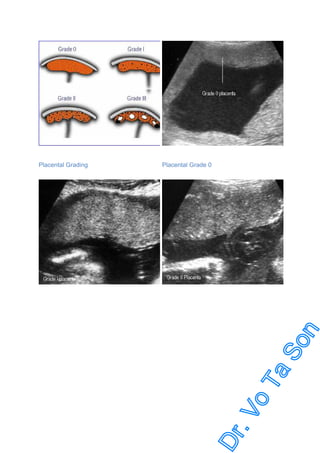 Placental Grading

Placental Grade 0

 