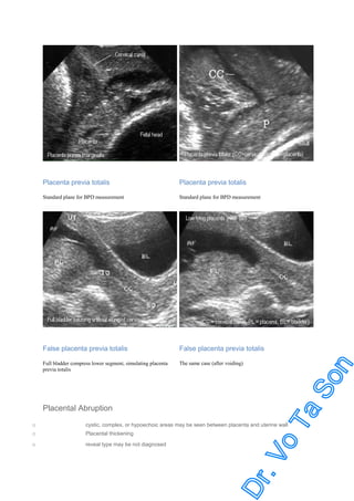 Placenta previa totalis

Placenta previa totalis

Standard plane for BPD measurement

Standard plane for BPD measurement

False placenta previa totalis

False placenta previa totalis

Full bladder compress lower segment, simulating placenta
previa totalis

The same case (after voiding)

Placental Abruption
o
o

cystic, complex, or hypoechoic areas may be seen between placenta and uterine wall

o

reveal type may be not diagnosed

Placental thickening

 