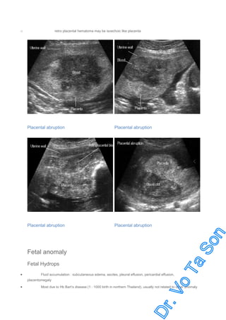 retro placental hematoma may be isoechoic like placenta

o

Placental abruption

Placental abruption

Placental abruption

Placental abruption

Fetal anomaly
Fetal Hydrops
•

Fluid accumulation : subcutaneous edema, ascites, pleural effusion, pericardial effusion,
placentomegaly

•

Most due to Hb Bart’s disease (1 : 1000 birth in northern Thailand), usually not related to other anomaly

 