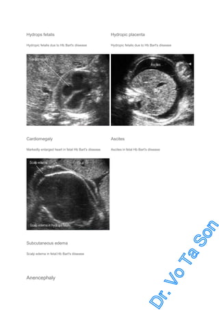 Hydrops fetalis

Hydropic placenta

Hydropic fetalis due to Hb Bart's diisease

Hydropic fetalis due to Hb Bart's diisease

Cardiomegaly

Ascites

Markedly enlarged heart in fetal Hb Bart's diisease

Ascites in fetal Hb Bart's diisease

Subcutaneous edema
Scalp edema in fetal Hb Bart's diisease

Anencephaly

 