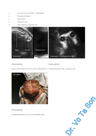 •

The most common NTDs (1: 1000 births)

•

Ultrasound findings

•

Absent skull

•

Prominent orbit

•

Often related to polyhydramnios

Anencephaly

Anencephaly

Base of skull contact with uterine wall / polyhydramnios

No skull above the orbits : Spectacle sign

Anencephaly
Postnatal appearance of a term anencephalic fetus

 