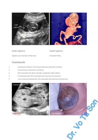 Cystic hygroma

Cystic hygroma

Septate cyst at the back of fetal neck

Postnatal finding

Omphalocele
•

A protrusion of bowel / liver through abdominal wall at the umbilicus

•

The protrusion covered by a membrane

•

50% associated with other anomalies, especially cardiac defects

•

If containing bowel, 80% associated with abnormal chromosomes

•

Liver-containing omphalocele: 20% associated with abnormal chromosomes

 