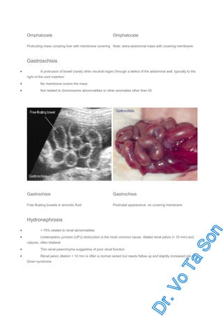 Omphalocele

Omphalocele

Protruding mass containg liver with membrane covering Note: extra-abdominal mass with covering membrane

Gastroschisis
•

A protrusion of bowel (rarely other visceral organ) through a defect of the abdominal wall, typically to the
right of the cord insertion

•

No membrane covers the mass

•

Not related to chromosome abnormalities or other anomalies other than GI

Gastrochisis

Gastrochisis

Free floating bowels in amniotic fluid

Postnatal appearance: no covering membrane

Hydronephrosis
•

> 75% related to renal abnormalities

•

Ureteropelvic junction (UPJ) obstruction is the most common cause: dilated renal pelvis (> 10 mm) and
calyces, often bilateral

•
•

Thin renal parenchyma suggestive of poor renal function
Renal pelvic dilation < 10 mm is often a normal variant but needs follow up and slightly increased risk of
Down syndrome

 