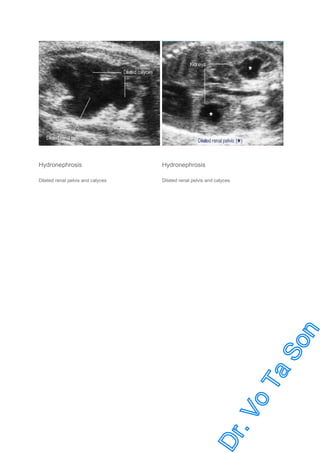 Hydronephrosis

Hydronephrosis

Dilated renal pelvis and calyces

Dilated renal pelvis and calyces

 