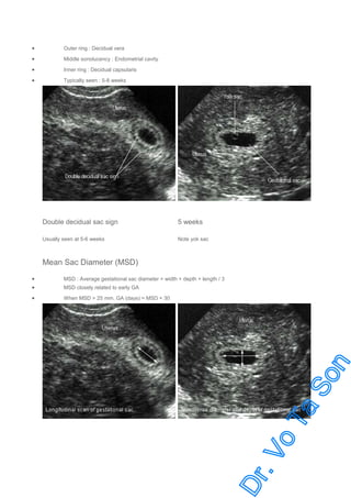 •

Outer ring : Decidual vera

•

Middle sonolucency : Endometrial cavity

•

Inner ring : Decidual capsularis

•

Typically seen : 5-8 weeks

Double decidual sac sign

5 weeks

Usually seen at 5-6 weeks

Note yok sac

Mean Sac Diameter (MSD)
•
•

MSD : Average gestational sac diameter = width + depth + length / 3

•

When MSD > 25 mm. GA (days) = MSD + 30

MSD closely related to early GA

 