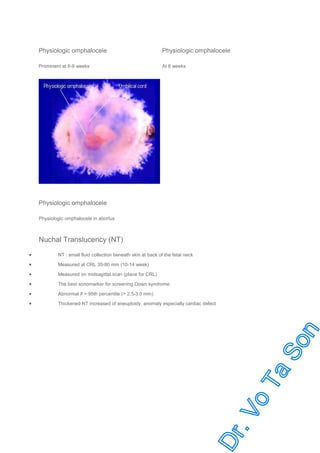 Physiologic omphalocele

Physiologic omphalocele

Prominent at 8-9 weeks

At 8 weeks

Physiologic omphalocele
Physiologic omphalocele in abortus

Nuchal Translucency (NT)
•

NT : small fluid collection beneath skin at back of the fetal neck

•

Measured at CRL 35-80 mm (10-14 week)

•

Measured on midsagittal scan (plane for CRL)

•

The best sonomarker for screening Down syndrome

•

Abnormal if > 95th percentile (> 2.5-3.0 mm)

•

Thickened NT increased of aneuploidy, anomaly especially cardiac defect

 