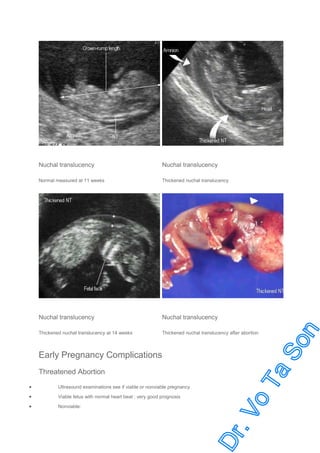 Nuchal translucency

Nuchal translucency

Normal measured at 11 weeks

Thickened nuchal translucency

Nuchal translucency

Nuchal translucency

Thickened nuchal translucency at 14 weeks

Thickened nuchal translucency after abortion

Early Pregnancy Complications
Threatened Abortion
•

Ultrasound examinations see if viable or nonviable pregnancy

•

Viable fetus with normal heart beat : very good prognosis

•

Nonviable:

 