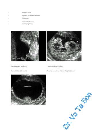 o

blighted ovum

o

missed / incomplete abortion

o

fetal death

o

ectopic pregnancy

o

molar pregnancy

Threatened abortion

Threatened abortion

Normal fetus at 11 weeks

Placental hematoma in case of blighted ovum

 