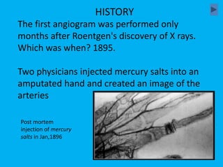 The first angiogram was performed only
months after Roentgen's discovery of X rays.
Which was when? 1895.
Two physicians injected mercury salts into an
amputated hand and created an image of the
arteries
HISTORY
Post mortem
injection of mercury
salts in Jan,1896
 