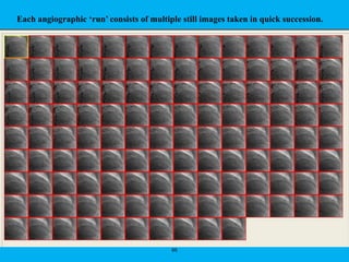 65
Each angiographic ‘run’ consists of multiple still images taken in quick succession.
 