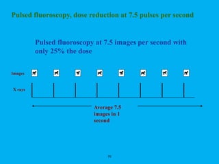 70
Pulsed fluoroscopy at 7.5 images per second with
only 25% the dose
Pulsed fluoroscopy, dose reduction at 7.5 pulses per second
Images
X rays
Average 7.5
images in 1
second
 