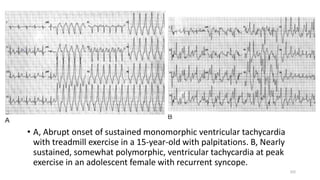 • A, Abrupt onset of sustained monomorphic ventricular tachycardia
with treadmill exercise in a 15-year-old with palpitations. B, Nearly
sustained, somewhat polymorphic, ventricular tachycardia at peak
exercise in an adolescent female with recurrent syncope.
102
 