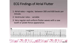 ECG Findings of Atrial Flutter
1. Atrial rates – regular, between 300 and 600 beats per
minute.
2. Ventricular rates - variable
3. Very regular and uniform flutter waves with a saw
tooth or picket fence appearance.
 