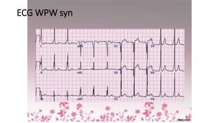 ECG WPW syn
 