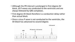 • Although the PR interval is prolonged in first-degree AV
block, all P waves are conducted to the ventricles and are
always followed by QRS complexes.
• First-degree AV block therefore is a conduction delay rather
than actual block.
• Once a sinus P wave is not conducted to the ventricles, the
AV block has advanced to second degree.
 