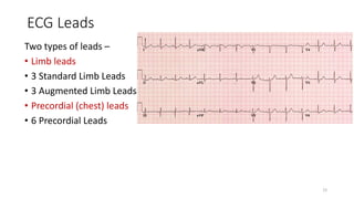 ECG Leads
Two types of leads –
• Limb leads
• 3 Standard Limb Leads
• 3 Augmented Limb Leads
• Precordial (chest) leads
• 6 Precordial Leads
12
 