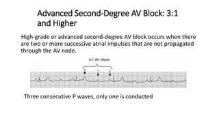 Advanced Second-Degree AV Block: 3:1
and Higher
High-grade or advanced second-degree AV block occurs when there
are two or more successive atrial impulses that are not propagated
through the AV node.
Three consecutive P waves, only one is conducted
 