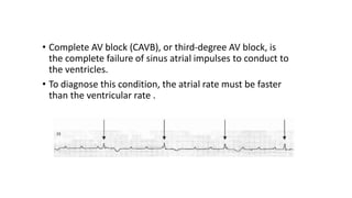• Complete AV block (CAVB), or third-degree AV block, is
the complete failure of sinus atrial impulses to conduct to
the ventricles.
• To diagnose this condition, the atrial rate must be faster
than the ventricular rate .
 