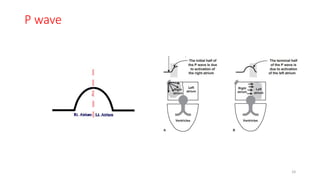 P wave
24
 