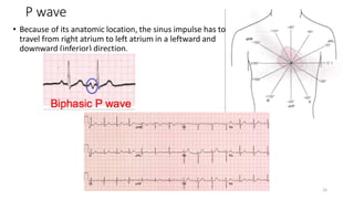 P wave
• Because of its anatomic location, the sinus impulse has to
travel from right atrium to left atrium in a leftward and
downward (inferior) direction.
25
 