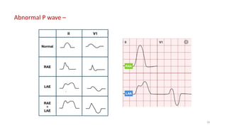 Abnormal P wave –
26
 