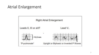 Atrial Enlargement
27
 