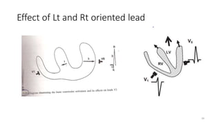 Effect of Lt and Rt oriented lead
34
 