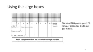 Using the large boxes
Standard ECG paper speed 25
mm per second or 1,500 mm
per minute.
56
 