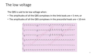 The low voltage
The QRS is said to be low voltage when:
• The amplitudes of all the QRS complexes in the limb leads are < 5 mm; or
• The amplitudes of all the QRS complexes in the precordial leads are < 10 mm
62
 