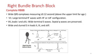 Right Bundle Branch Block
Complete RBBB
• Wide QRS complexes measuring ≥0.12 second (above the upper limit for age )
• V1: Large terminal R’ waves with rR’ or rsR’ configuration.
• V6 ,leads I and aVL: Wide terminal S waves. Septal q waves are preserved.
• Wide and slurred S in leads II, III, and aVF.
63
 