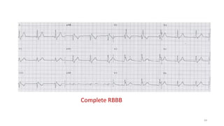 64
Complete RBBB
 