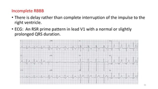 Incomplete RBBB
• There is delay rather than complete interruption of the impulse to the
right ventricle.
• ECG: An RSR prime pattern in lead V1 with a normal or slightly
prolonged QRS duration.
65
 