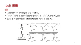 Left BBB
ECG –
• an abnormally prolonged QRS duration,
• absent normal initial forces (no Q waves in leads aVL and V6), and
• QS or rS in lead V1 and a tall notched R wave in lead V6).
66
 