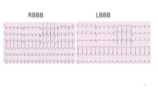 LBBB
RBBB
67
 