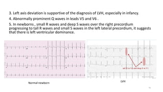 3. Left axis deviation is supportive of the diagnosis of LVH, especially in infancy.
4. Abnormally prominent Q waves in leads V5 and V6 .
5. In newborns , small R waves and deep S waves over the right precordium
progressing to tall R waves and small S waves in the left lateral precordium, it suggests
that there is left ventricular dominance.
Normal newborn
LVH
70
 