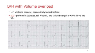 LVH with Volume overload
• Left ventricle becomes eccentrically hypertrophied.
• ECG - prominent Q waves, tall R waves, and tall and upright T waves in V5 and
V6.
73
 