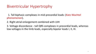 Biventricular Hypertrophy
1. Tall biphasic complexes in mid-precordial leads: (Katz-Wachtel
phenomenon).
2. Right atrial enlargement combined with LVH
3. Voltage discordance - tall QRS complexes in precordial leads, whereas
low voltages in the limb leads, especially bipolar leads I, II, III.
77
 