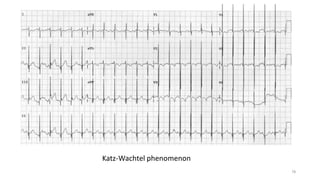 Katz-Wachtel phenomenon
78
 