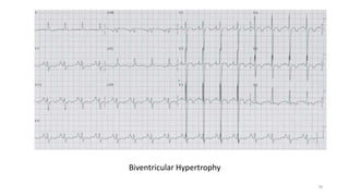 Biventricular Hypertrophy
79
 