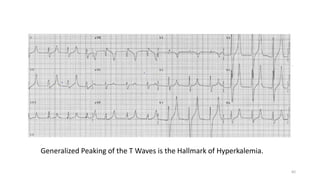 Generalized Peaking of the T Waves is the Hallmark of Hyperkalemia.
82
 